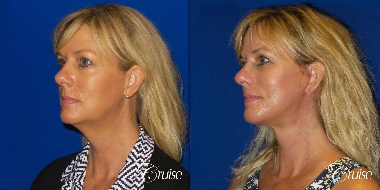 Neck Lift With Lower Face Lift - Before and After 3