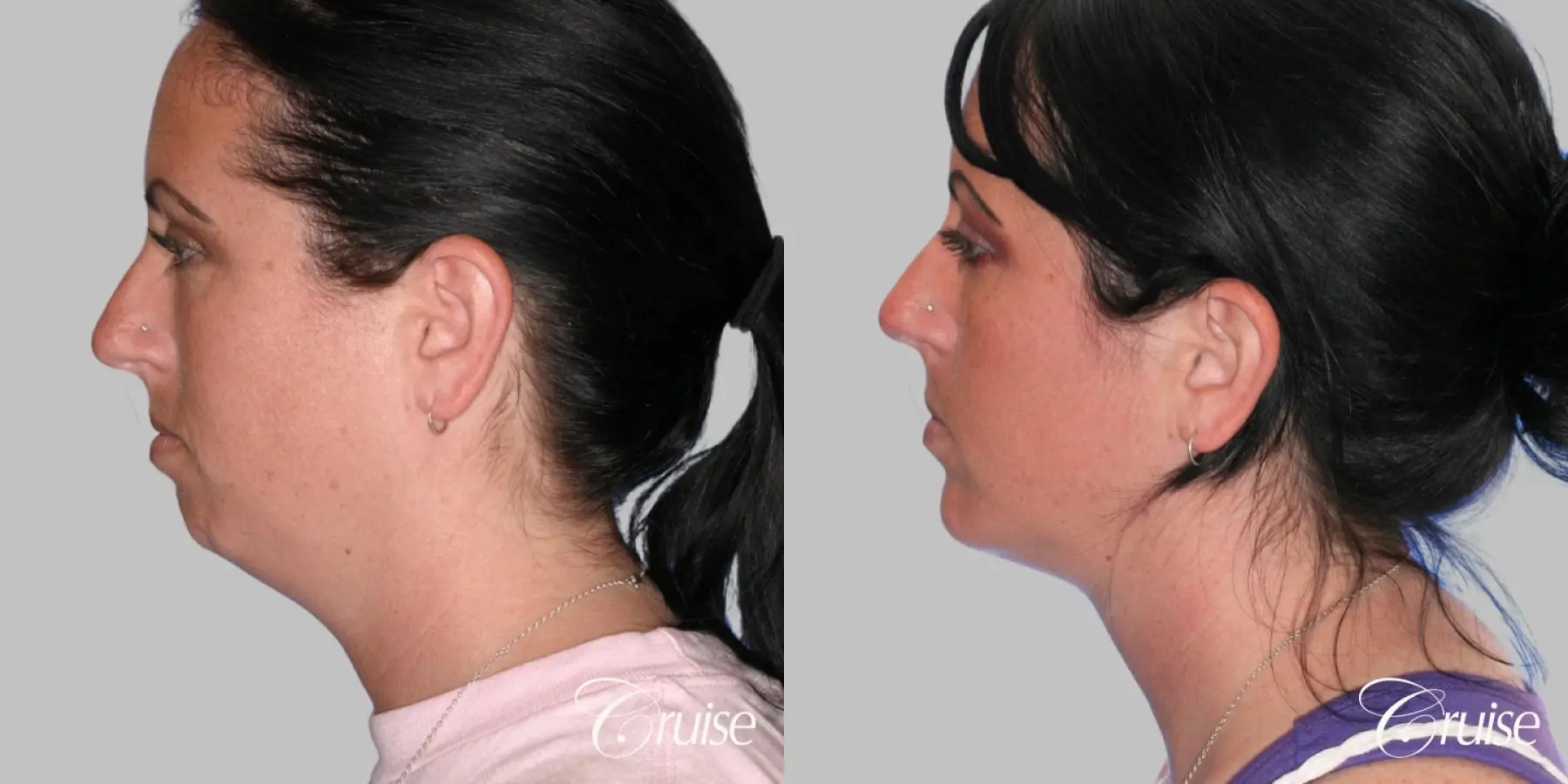 Neck Lift with Chin Augmentation - Female - Before and After 2