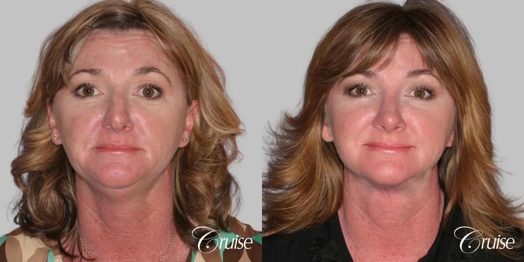 Lower Facelift, Neck Midline Plication - Female Patient - Before and After 1