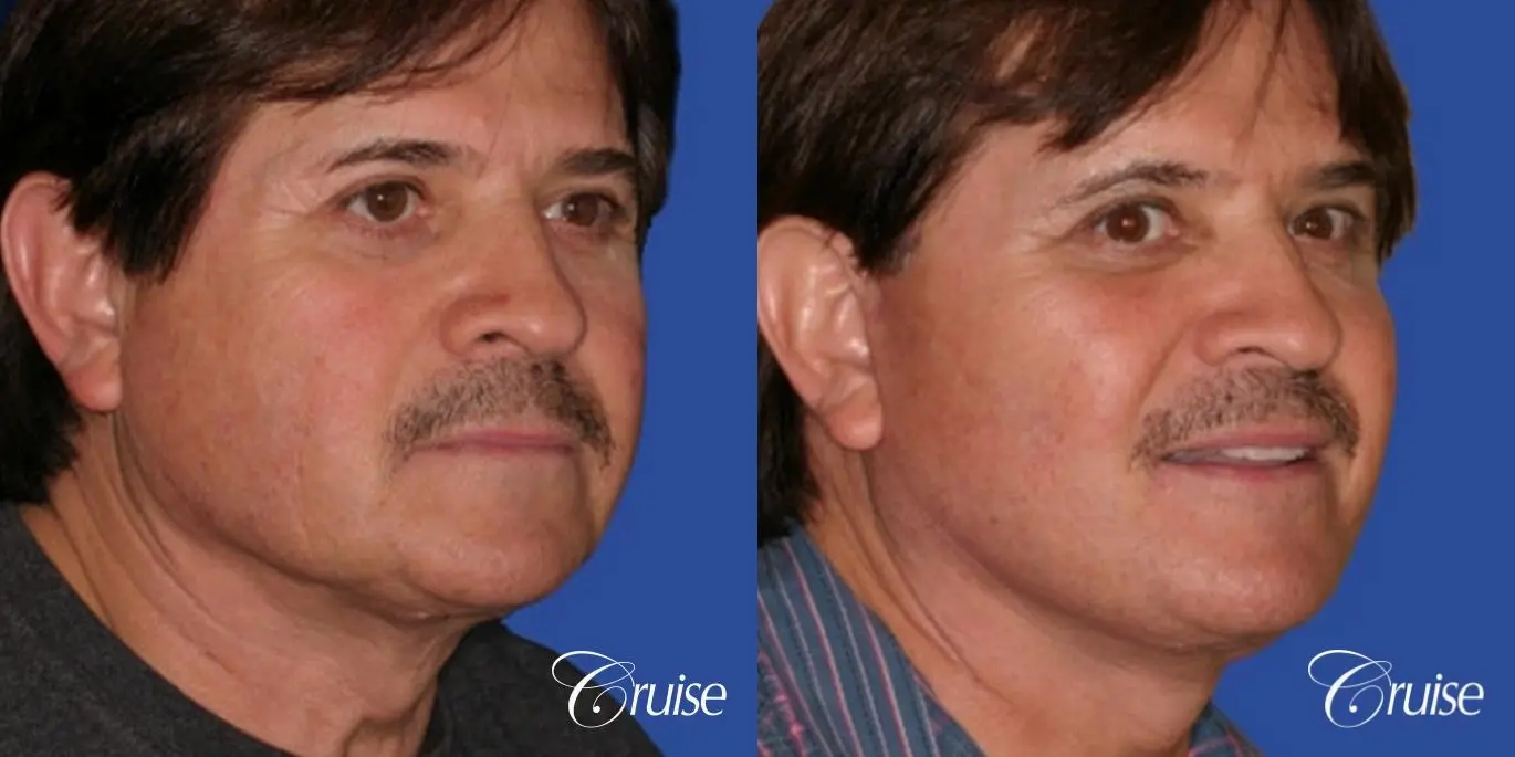 Neck Lift - Before and After 3