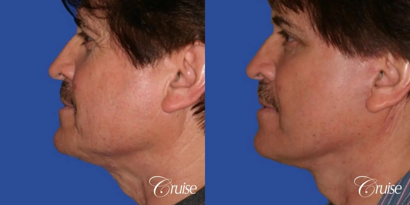 Neck Lift - Before and After 2