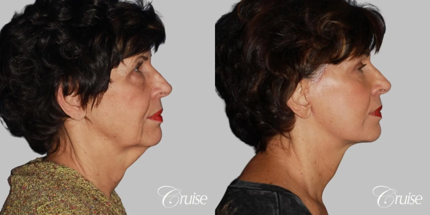 facelift surgery dr. cruise - Before and After 3