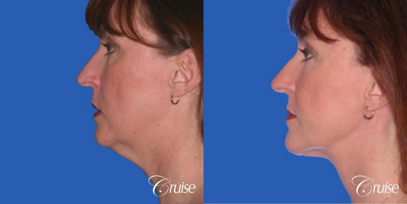 Neck Lift - Before and After 2