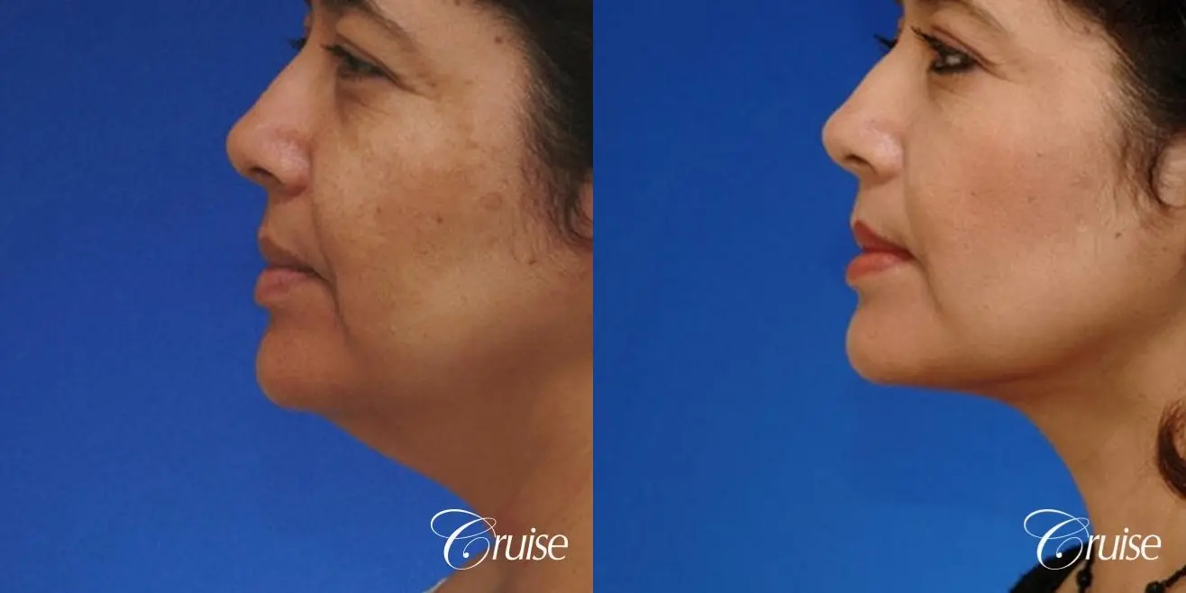 Neck Lift - Before and After 2