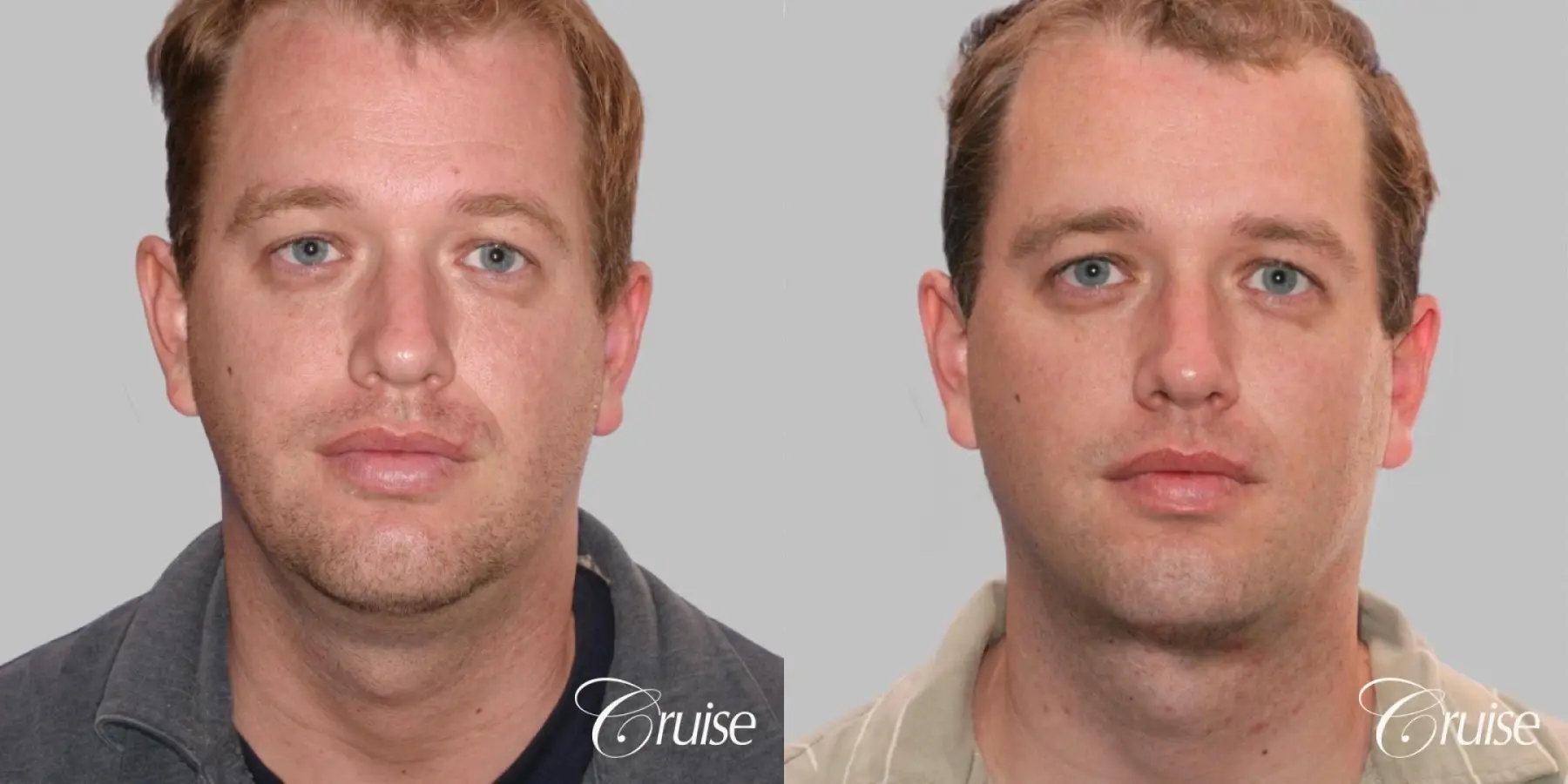 Lower Face Lift, Neck Lift, Neck Midline Plication - Before and After  