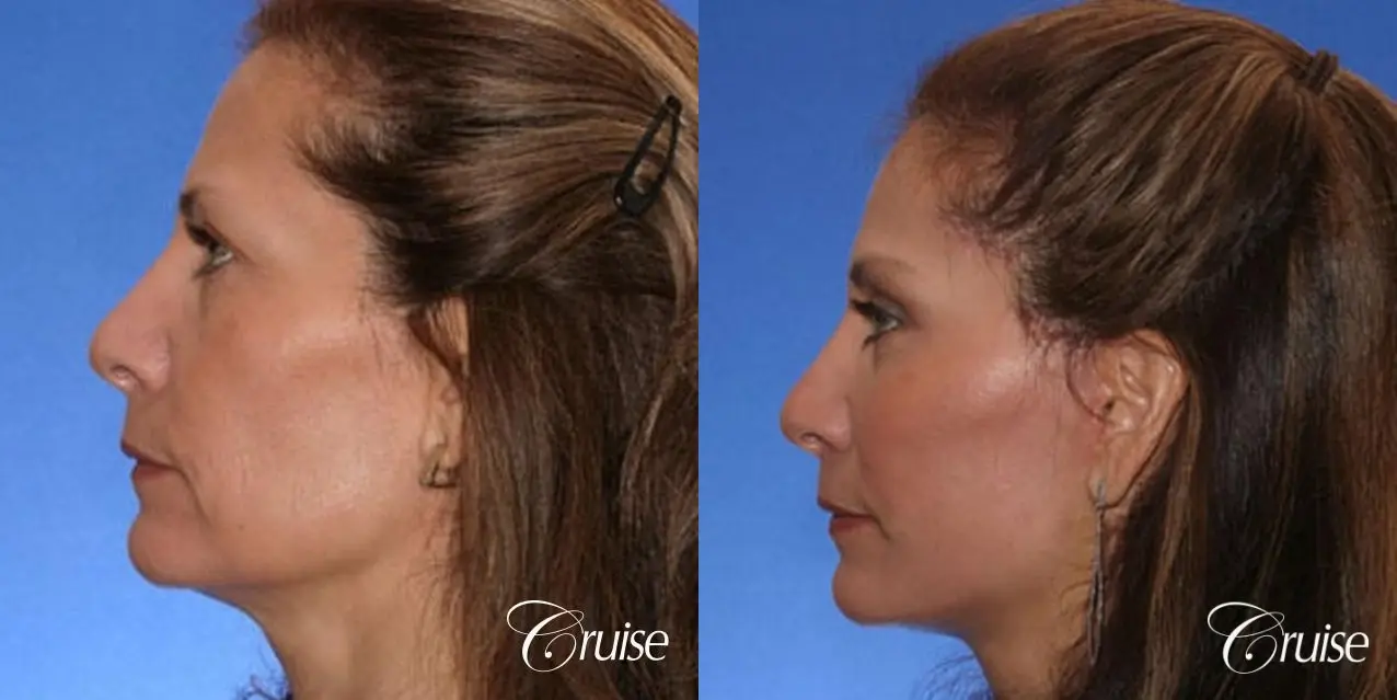 Neck Lift With FaceLift - Before and After 2