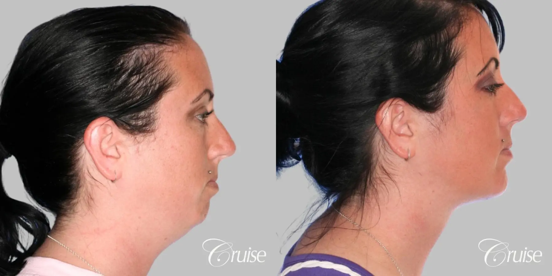 Neck Lift with Chin Augmentation - Female - Before and After 3