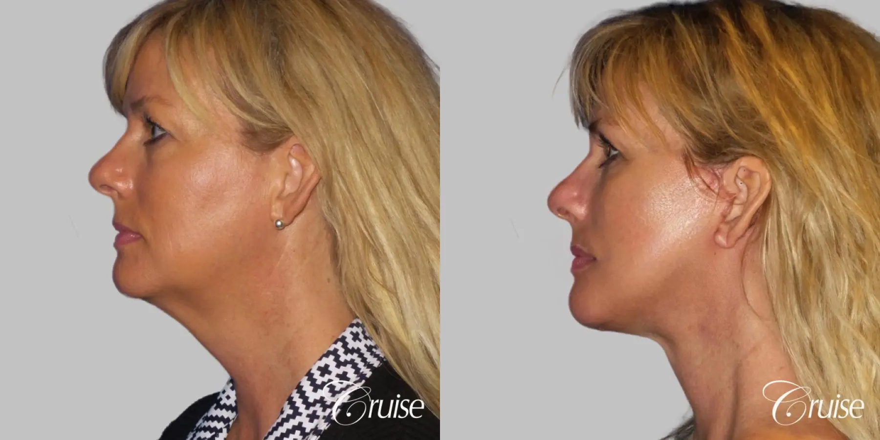 Neck Lift With Lower Face Lift - Before and After 3