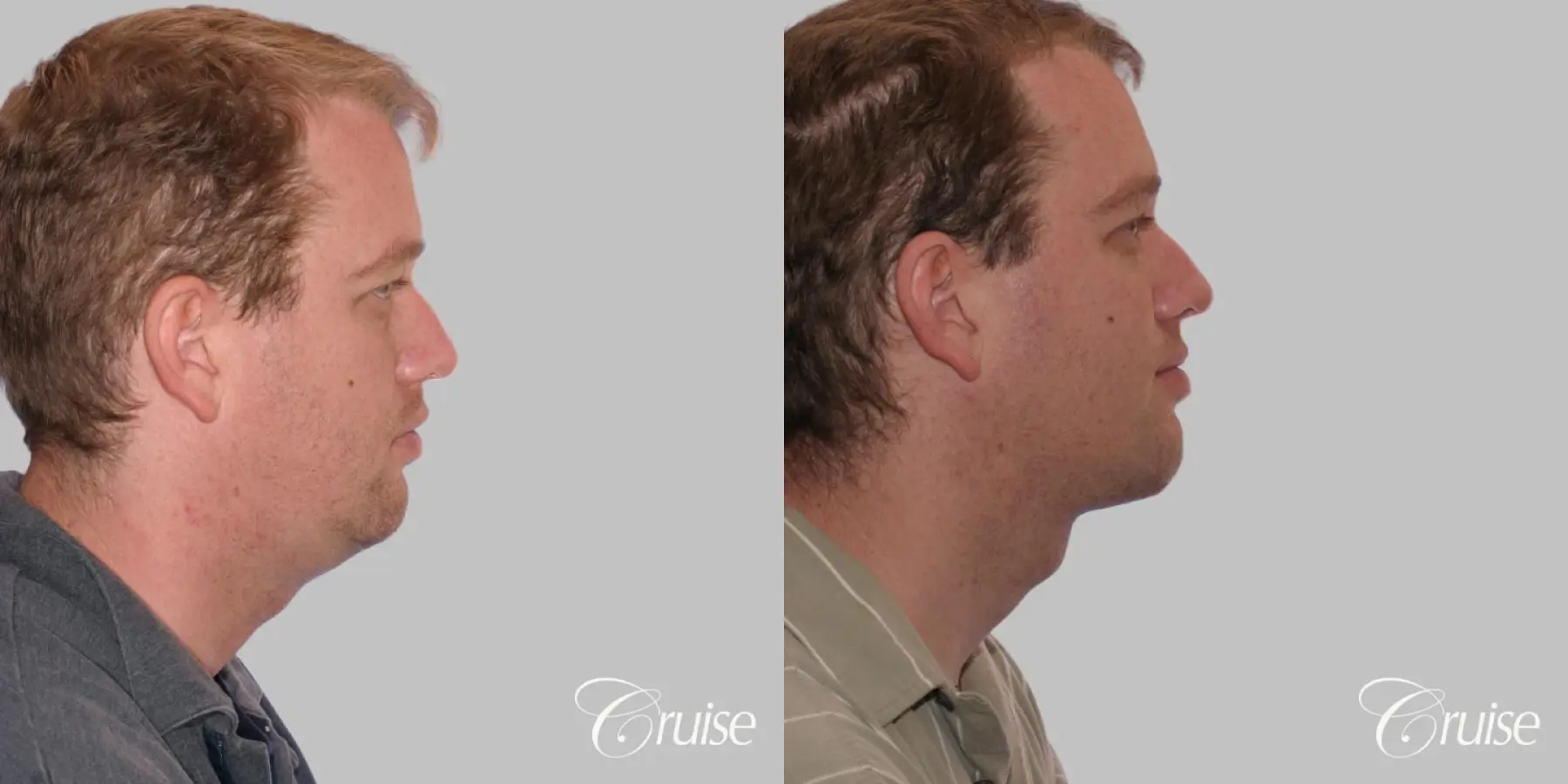 Lower Face Lift, Neck Lift, Neck Midline Plication - Before and After 3