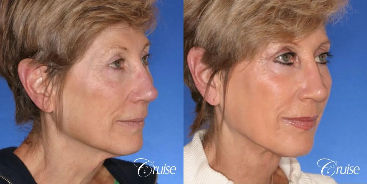 Neck Lift - Before and After 2