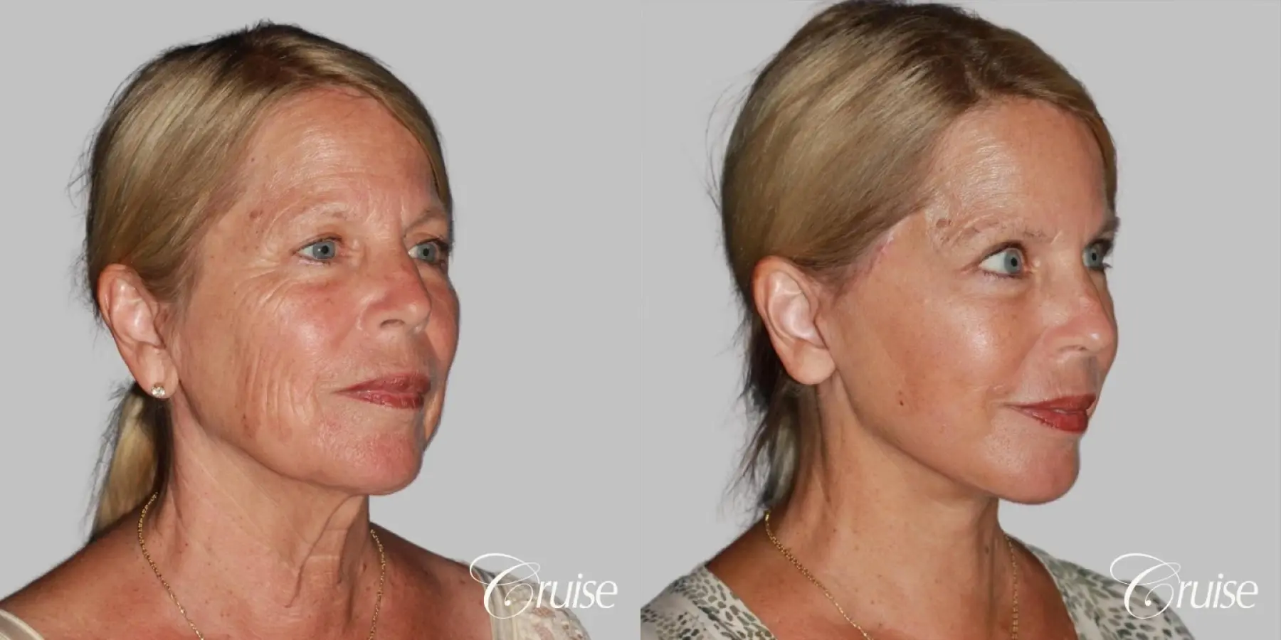 Neck Lift: Patient 20 - Before and After 3