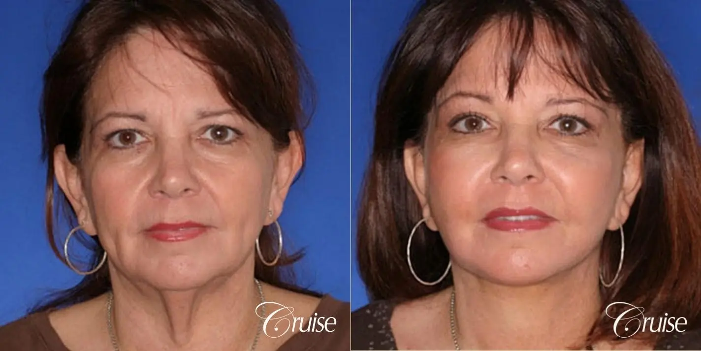 Neck Lift - Before and After  