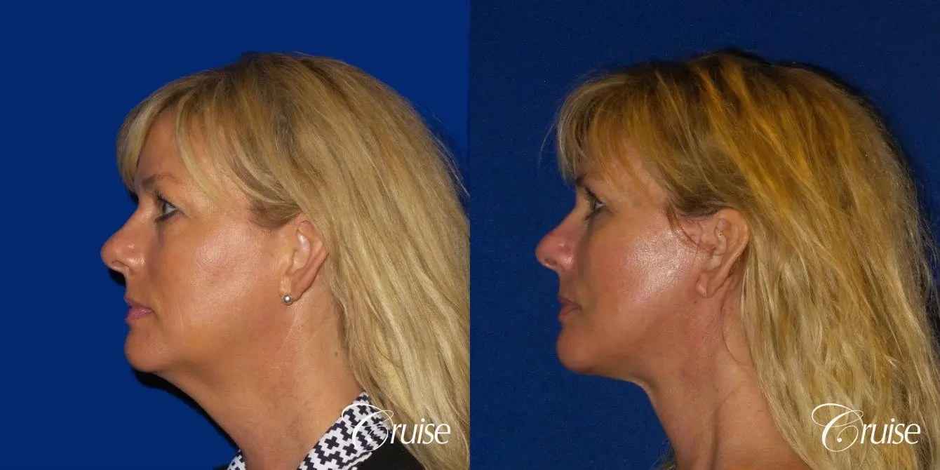 Neck Lift With Lower Face Lift - Before and After 4