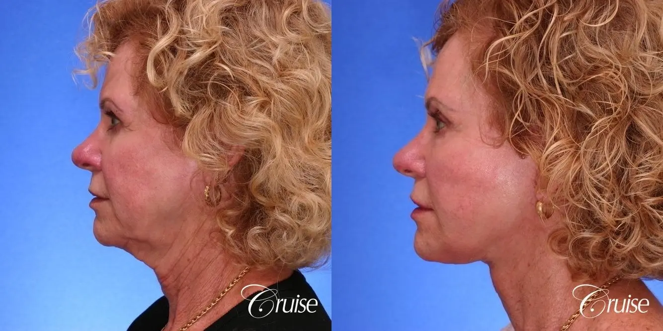 Neck Lift - Before and After 2