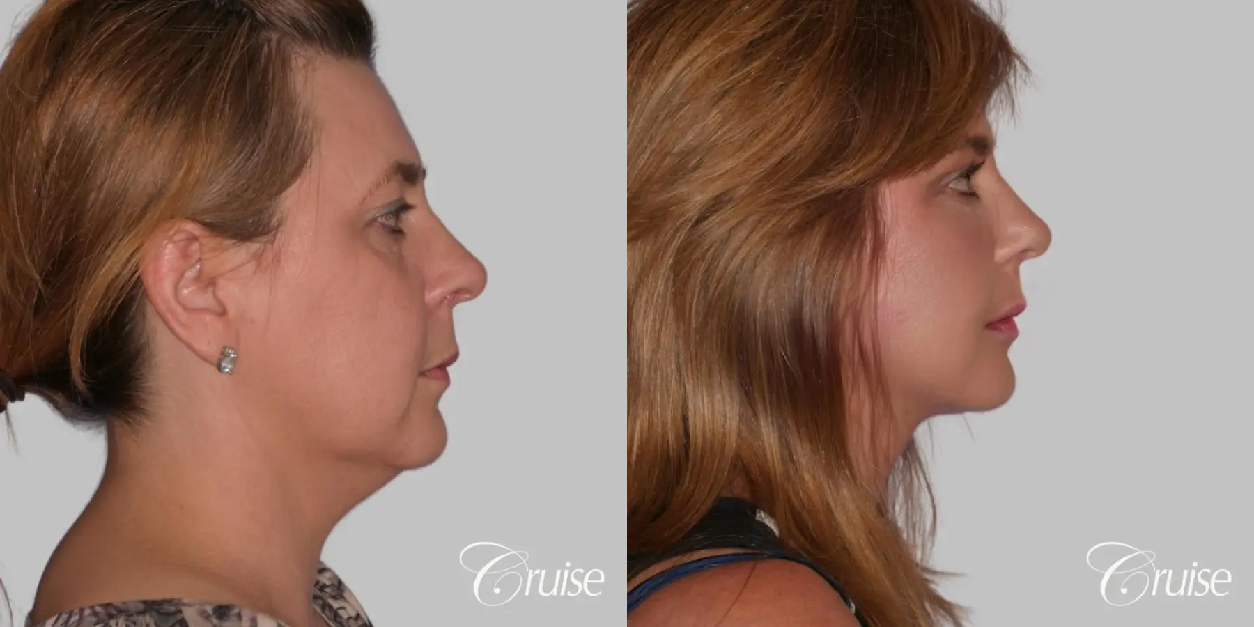 Facelift in Newport Beach, CA - Before and After 3