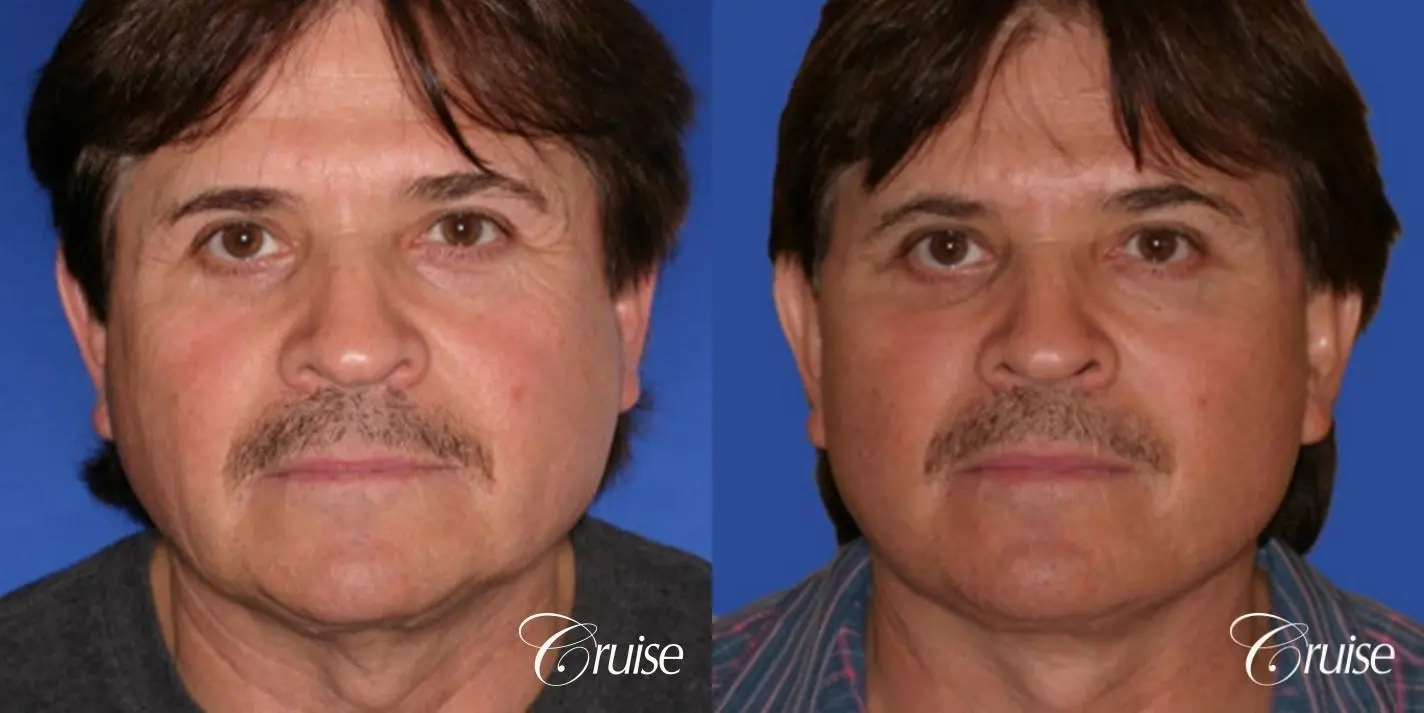 Neck Lift - Before and After 1