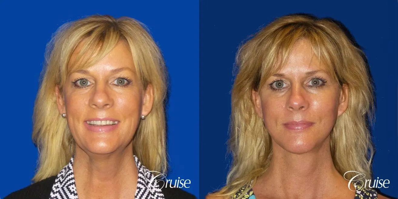 Neck Lift With Lower Face Lift - Before and After 1