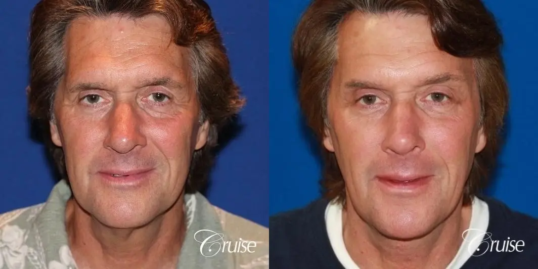 Neck Lift - Before and After  