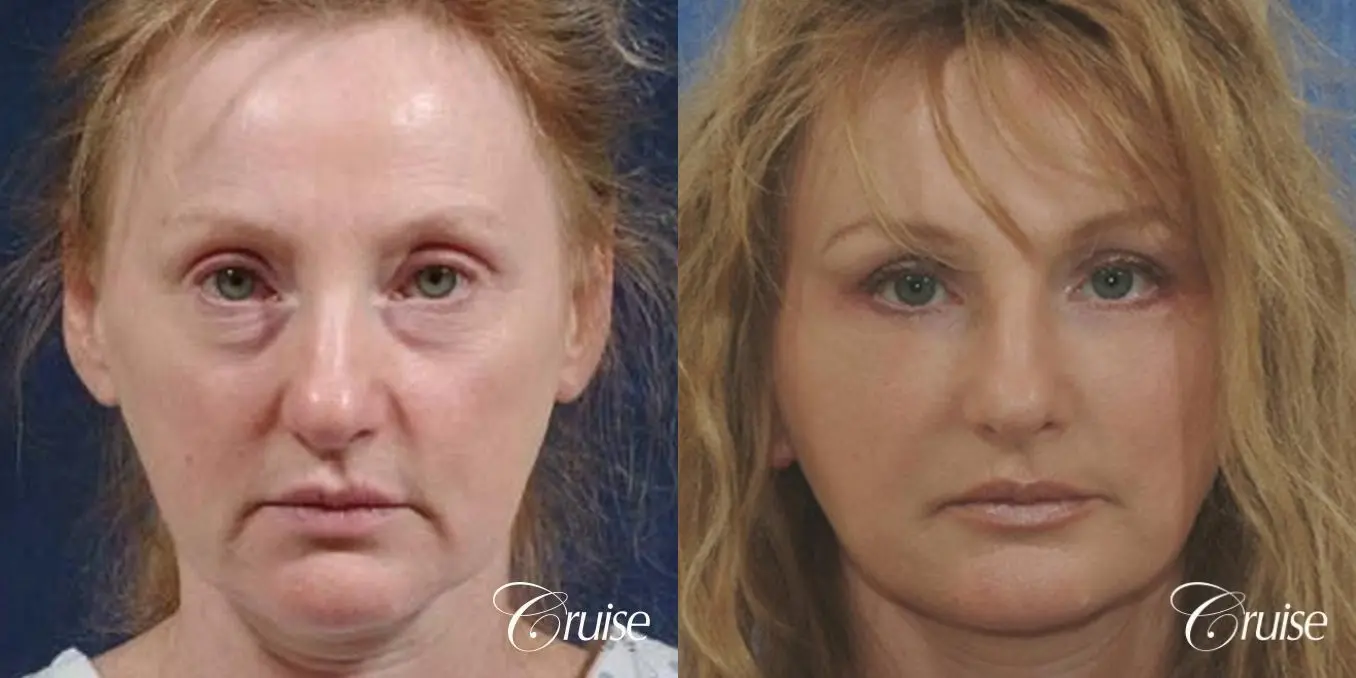Face Lift - Before and After 1