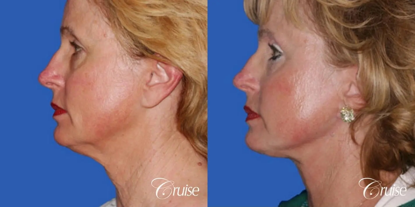 Neck Lift - Before and After 2