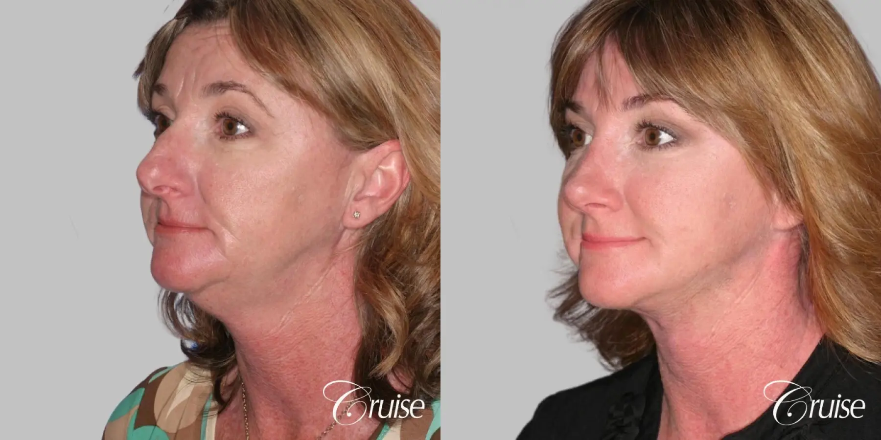 Lower Facelift, Neck Midline Plication - Female Patient - Before and After 2