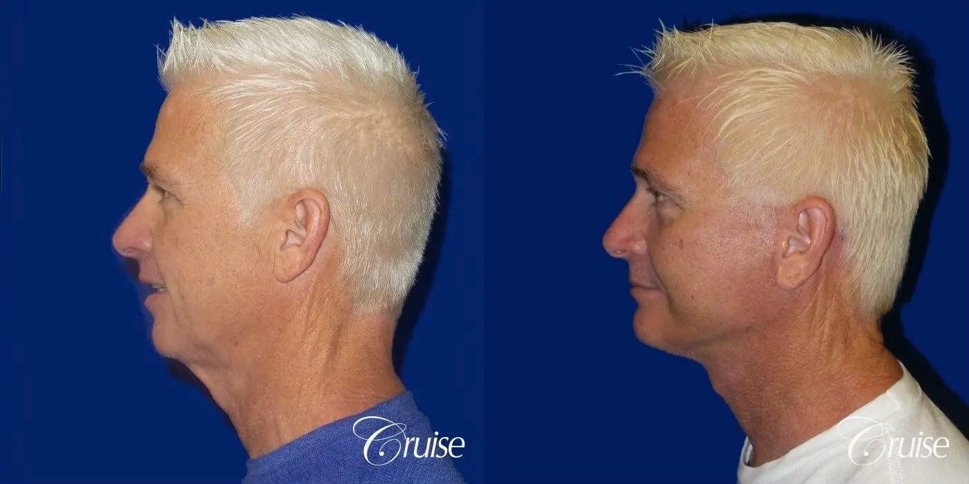 Male neck lift before and after - Before and After 3
