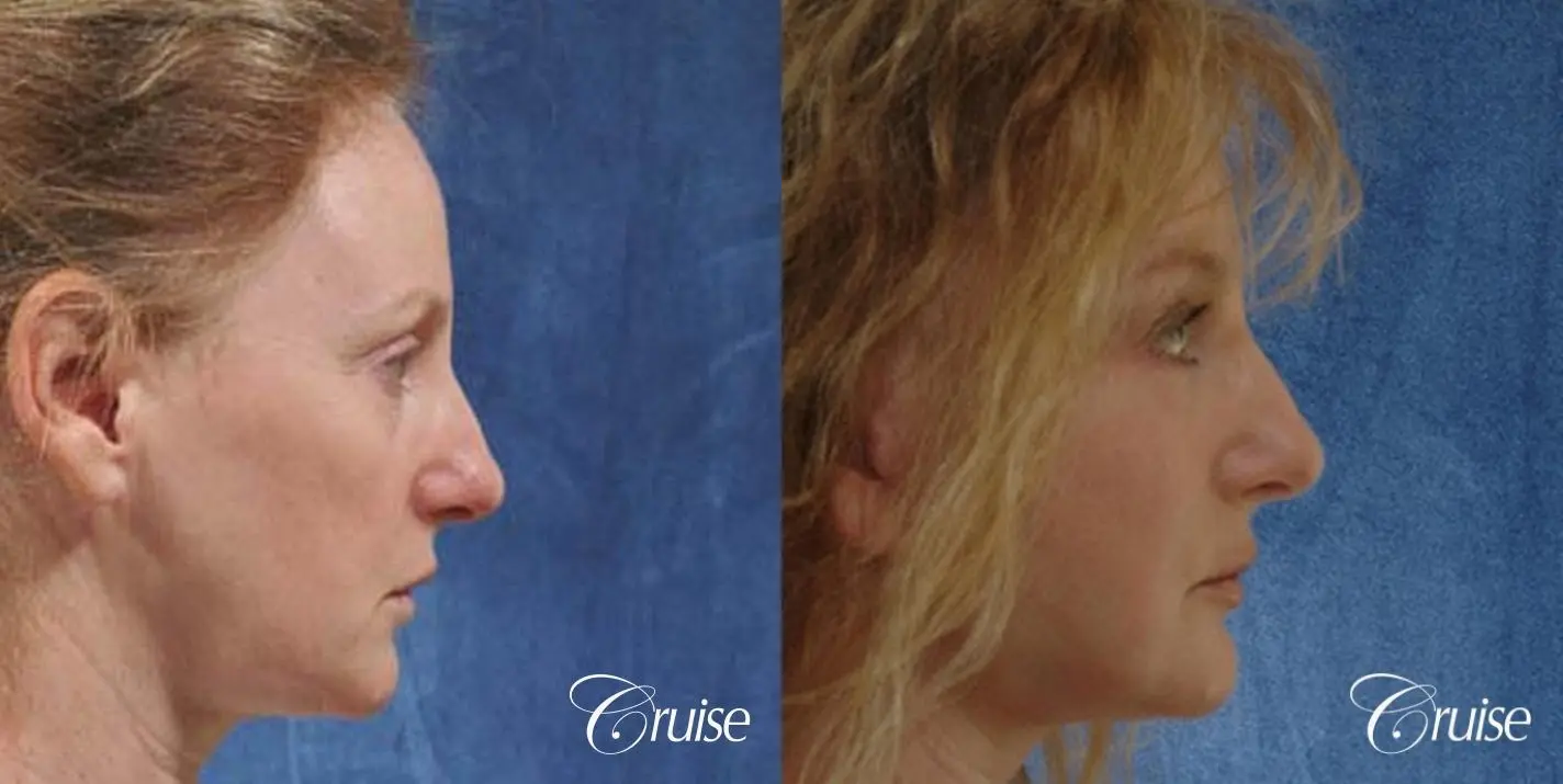 Face Lift - Before and After 3