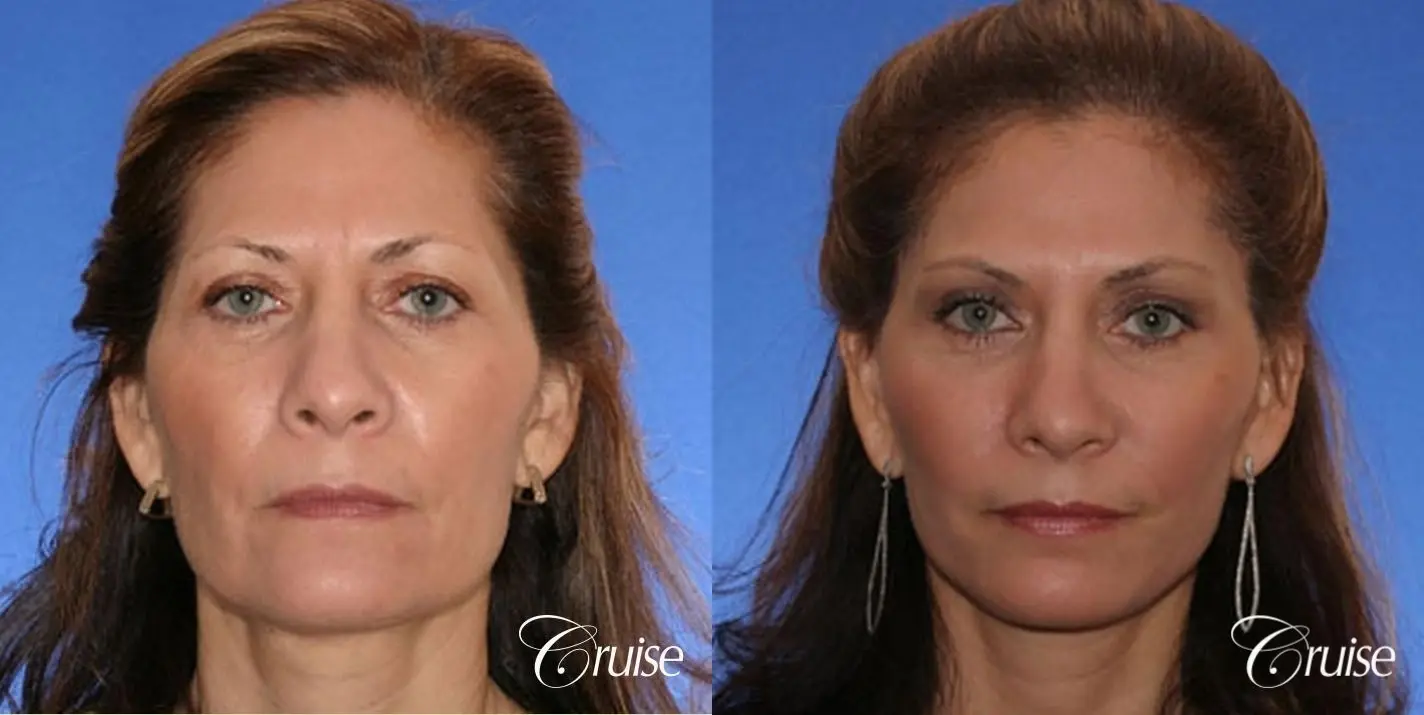 Neck Lift With FaceLift - Before and After 1