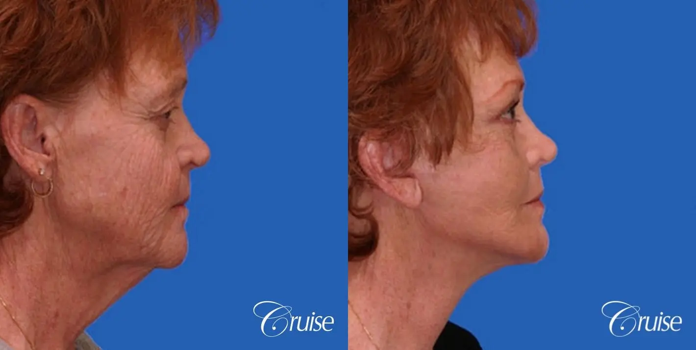 Neck Lift - Before and After 3