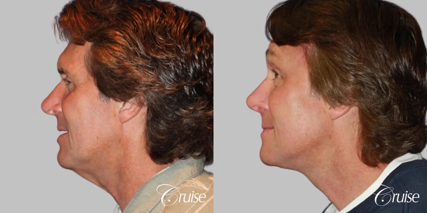 Neck Lift with Liposuction Jawline - Before and After 2