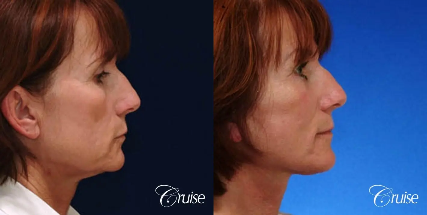 Neck Lift - Before and After 3