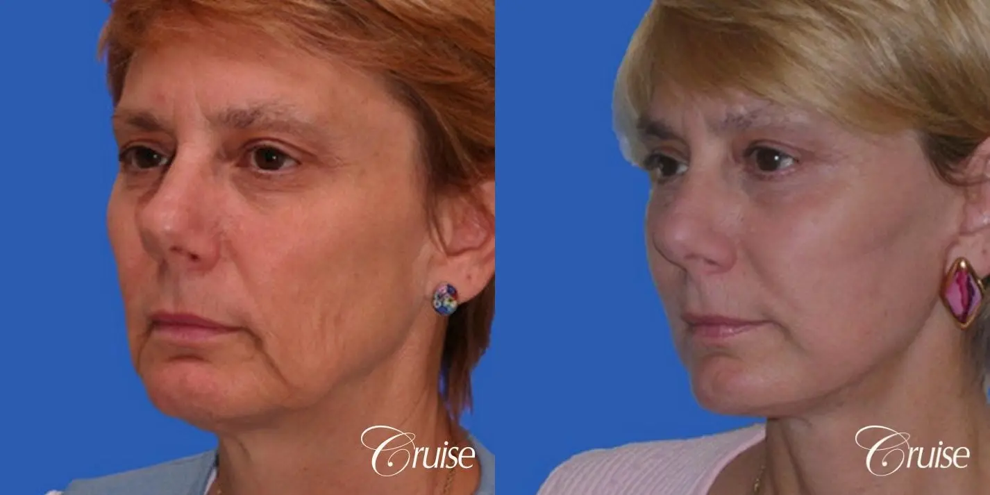 Neck Lift - Before and After 3