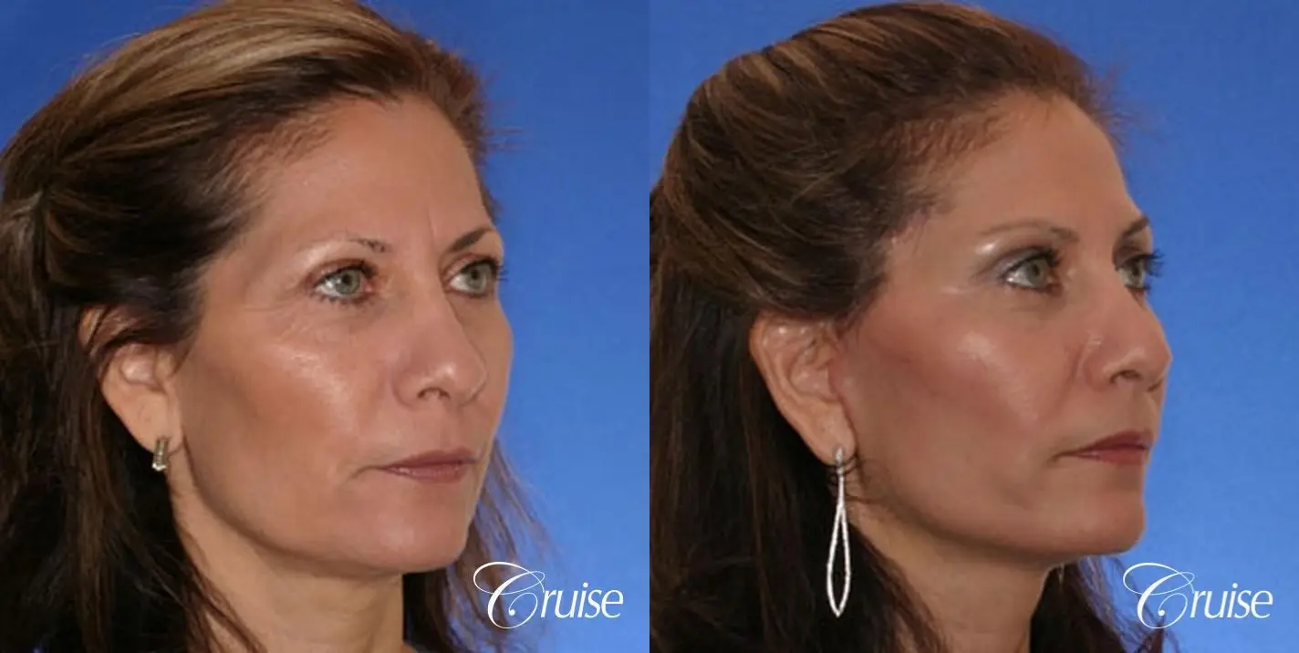 Neck Lift With FaceLift - Before and After 3
