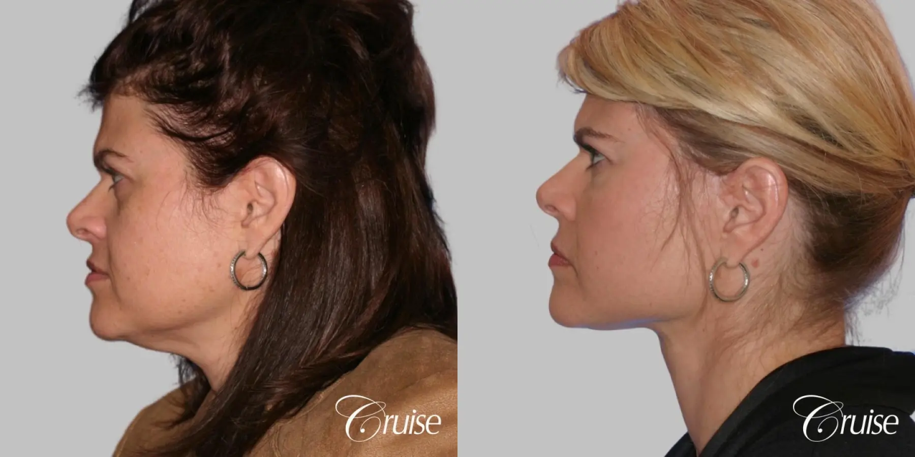 Facelift - Before and After 3