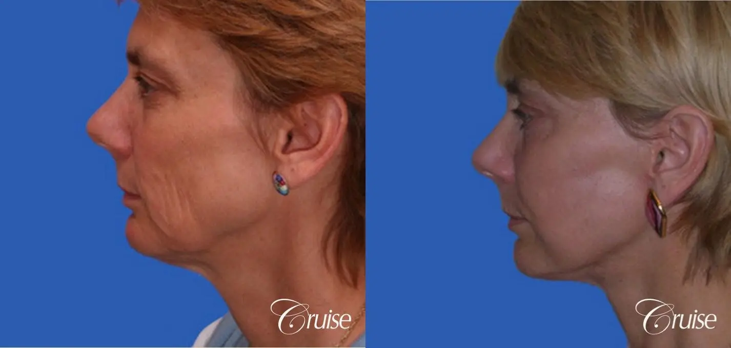 Neck Lift - Before and After 2