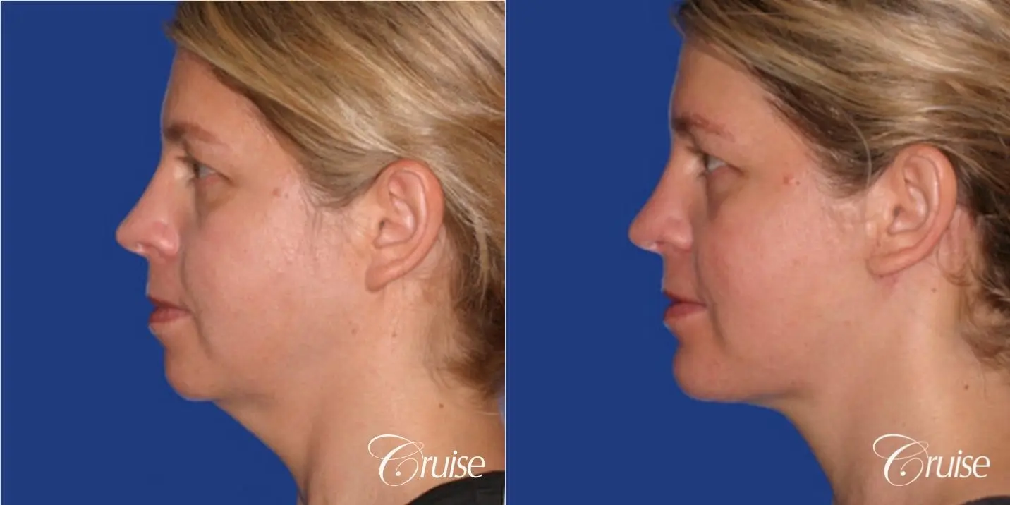 Neck Lift - Before and After 2