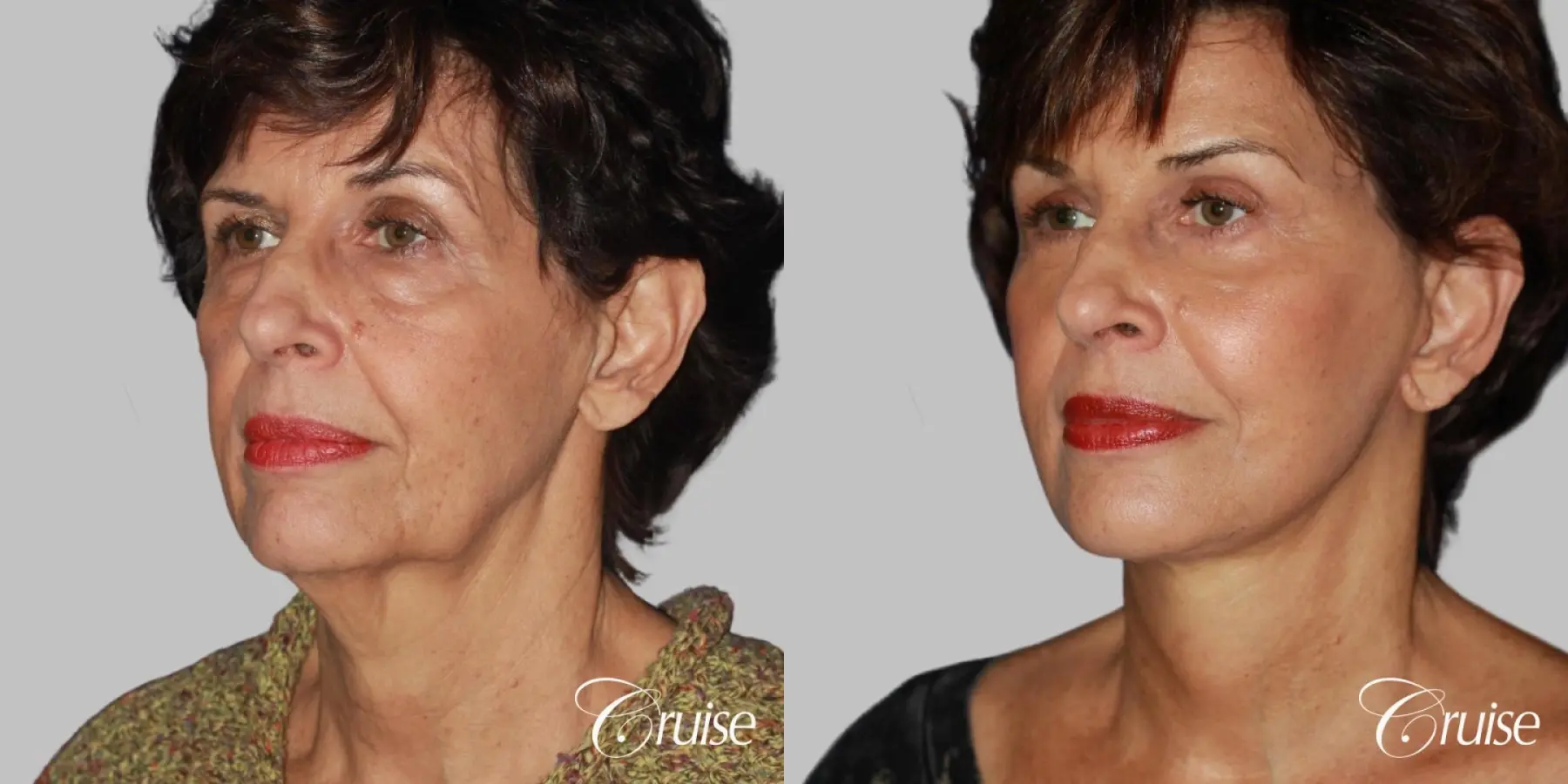 facelift surgery dr. cruise - Before and After 2