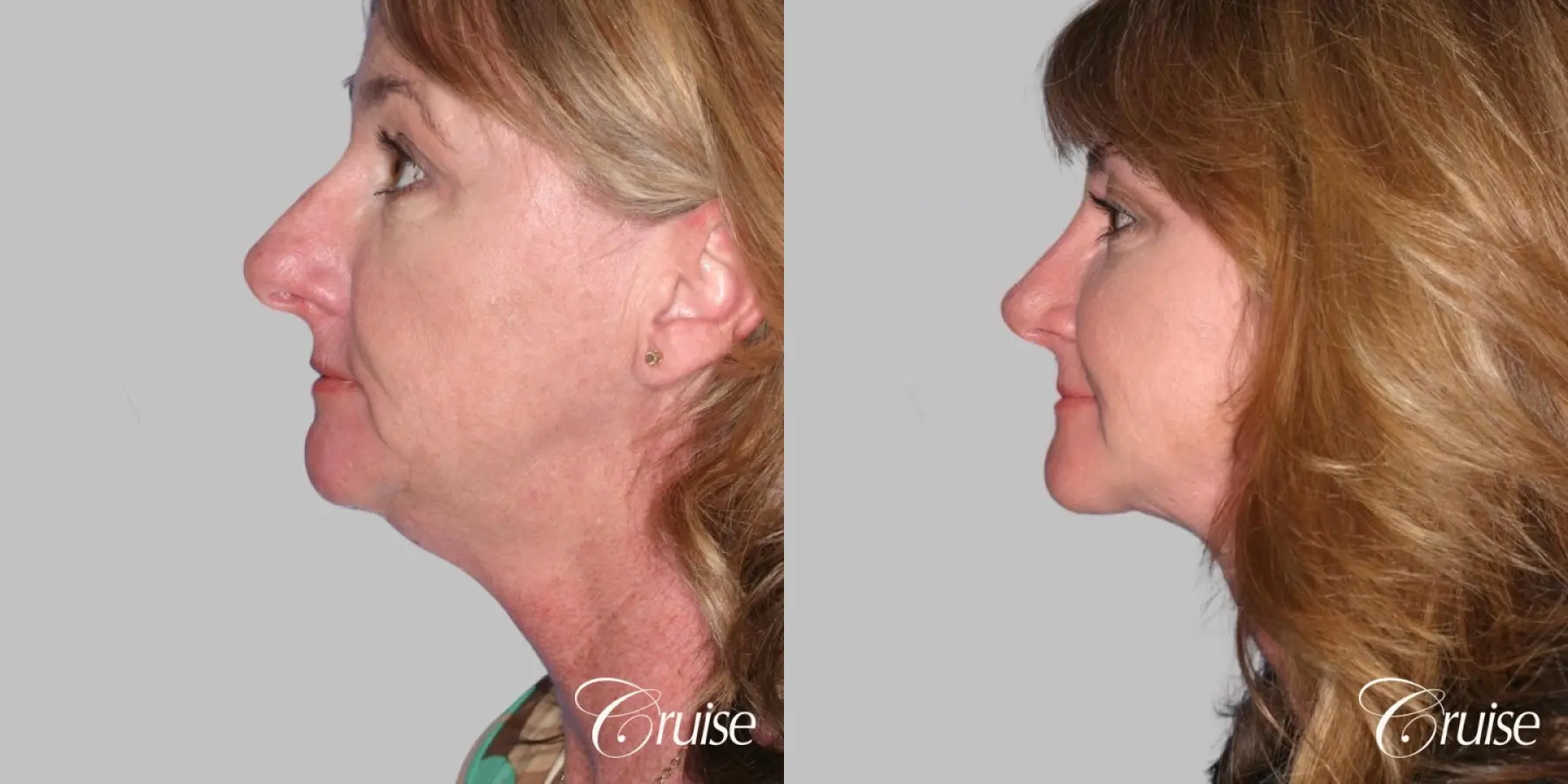 Lower Facelift, Neck Midline Plication - Female Patient - Before and After 3