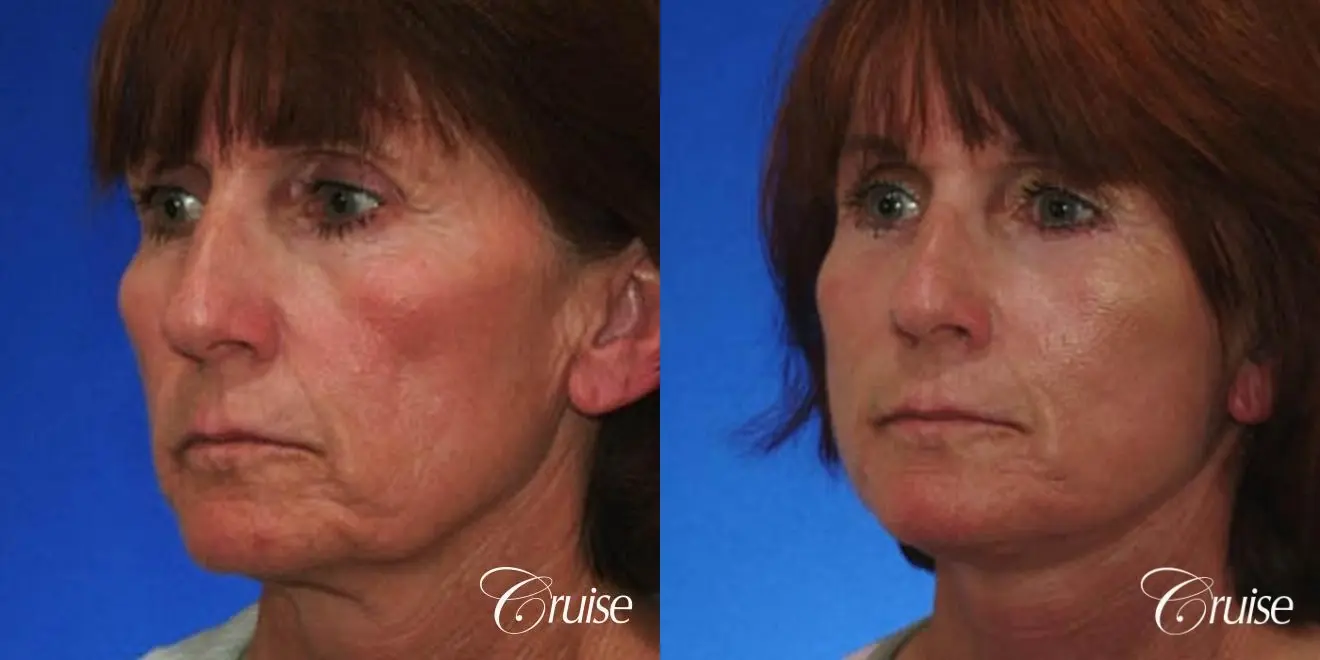 Neck Lift - Before and After 2