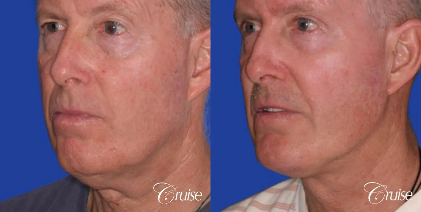 Neck Lift - Before and After 2