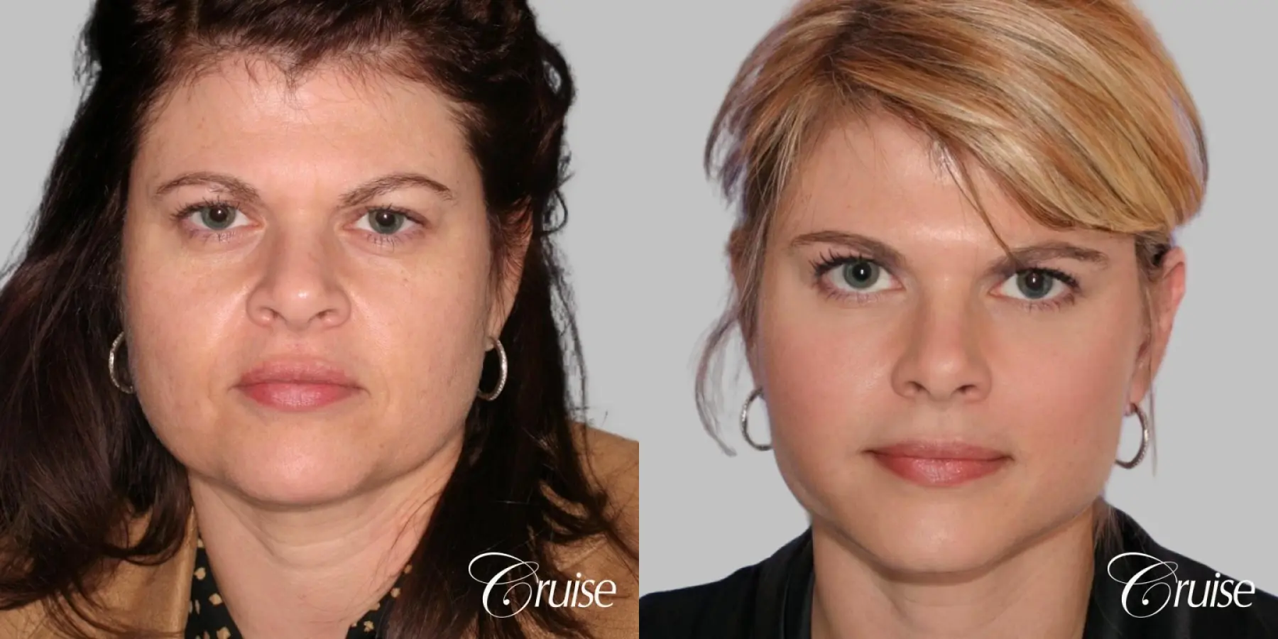 Facelift - Before and After 1