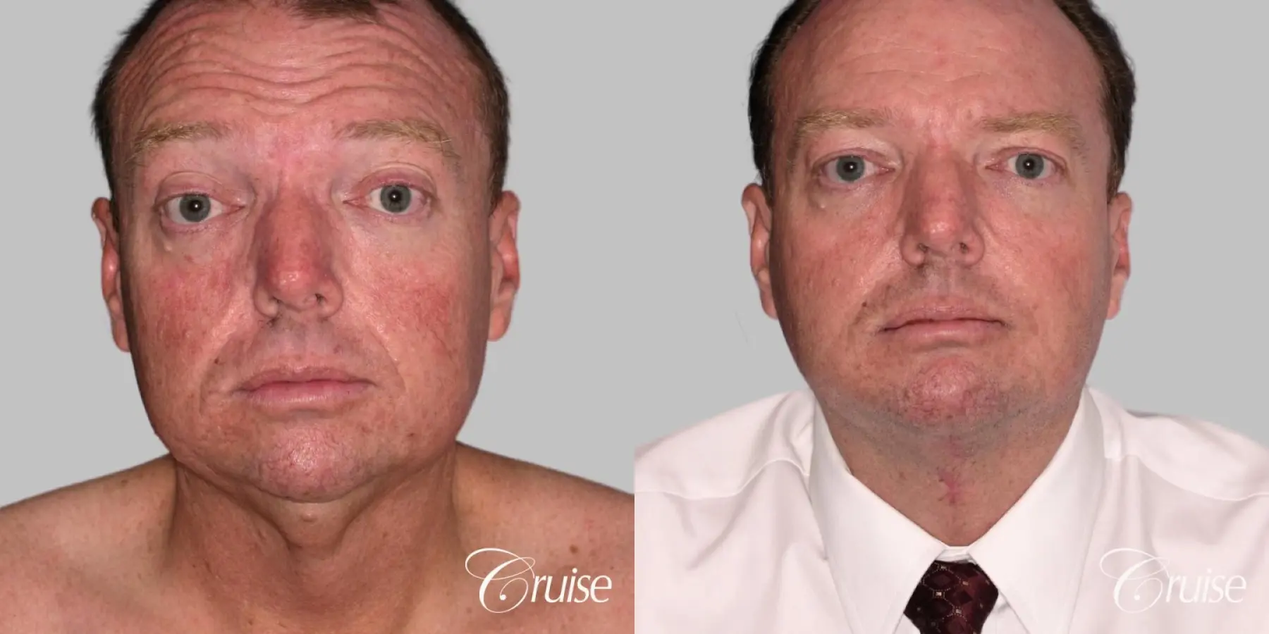 Lower Facelift, Necklift - Male Patient - Before and After 1