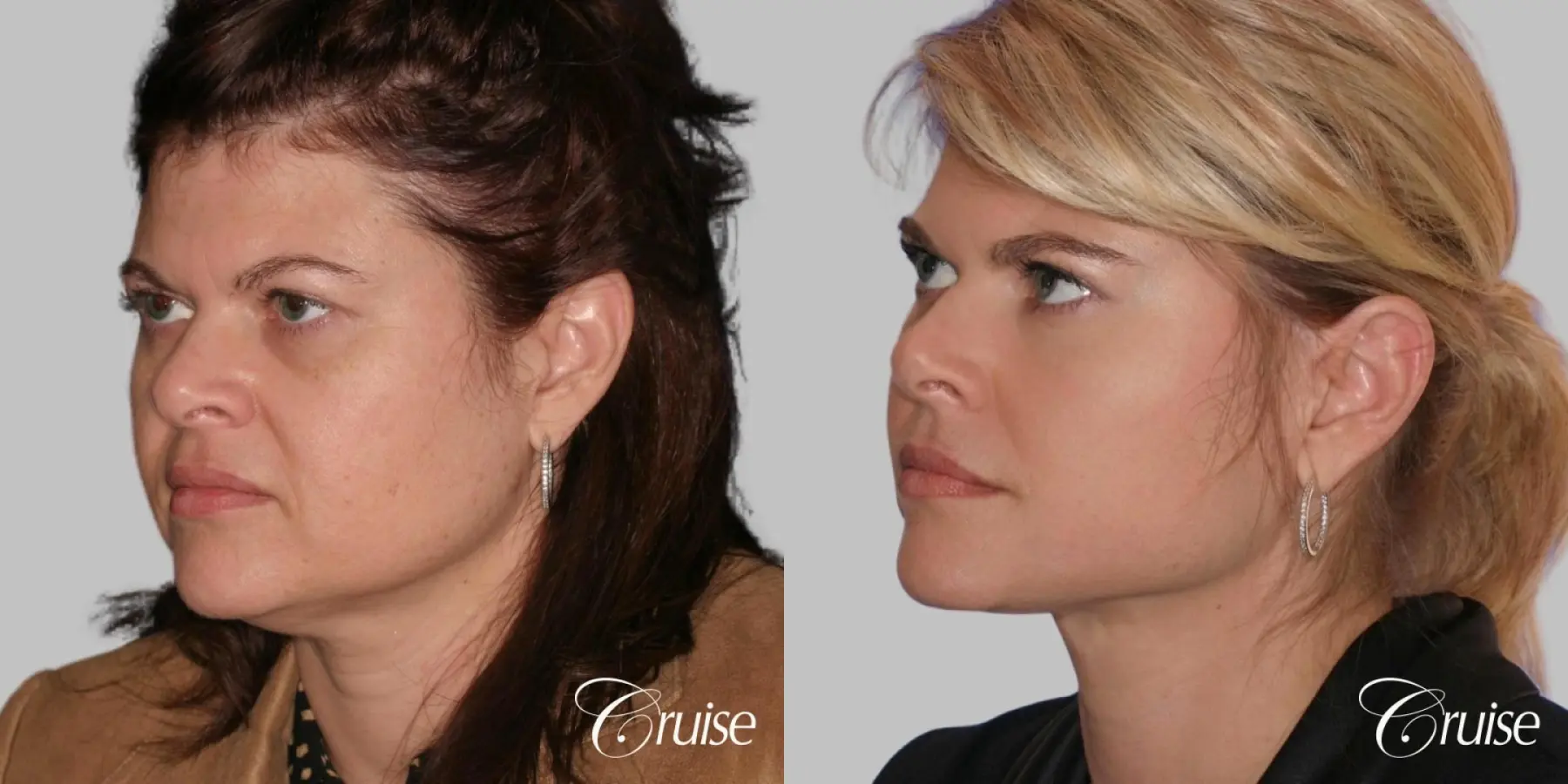 Facelift - Before and After 2