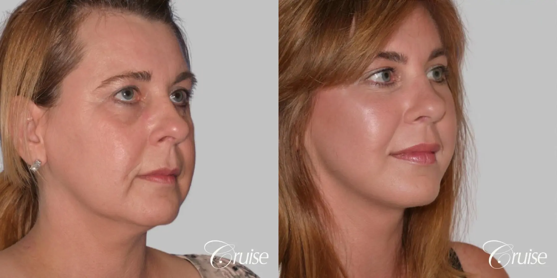 Facelift in Newport Beach, CA - Before and After 2