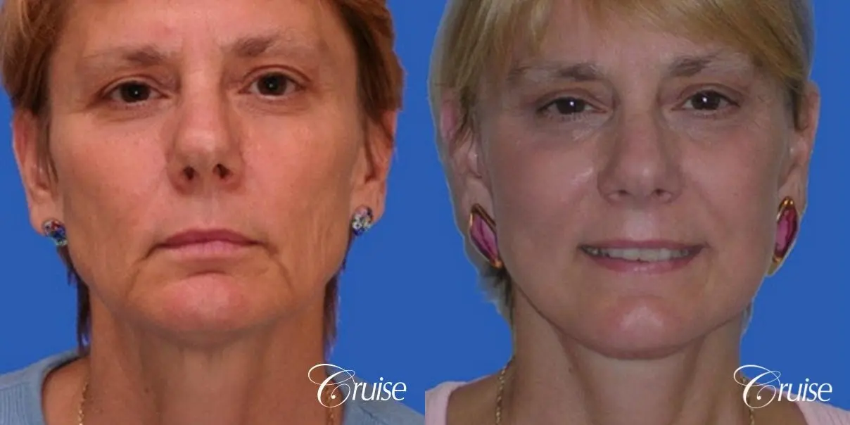 Neck Lift - Before and After 1