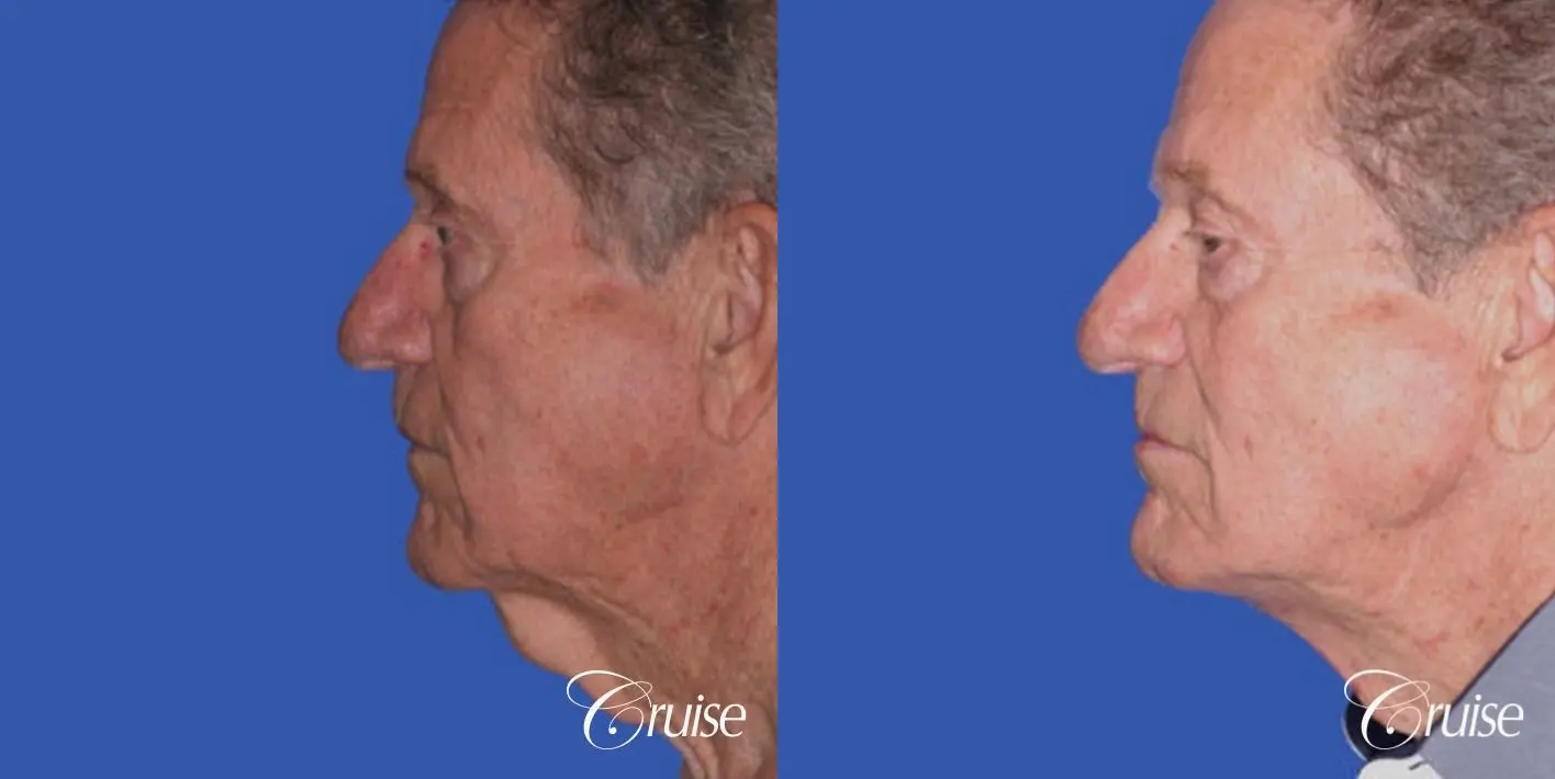 Neck Lift - Before and After 2