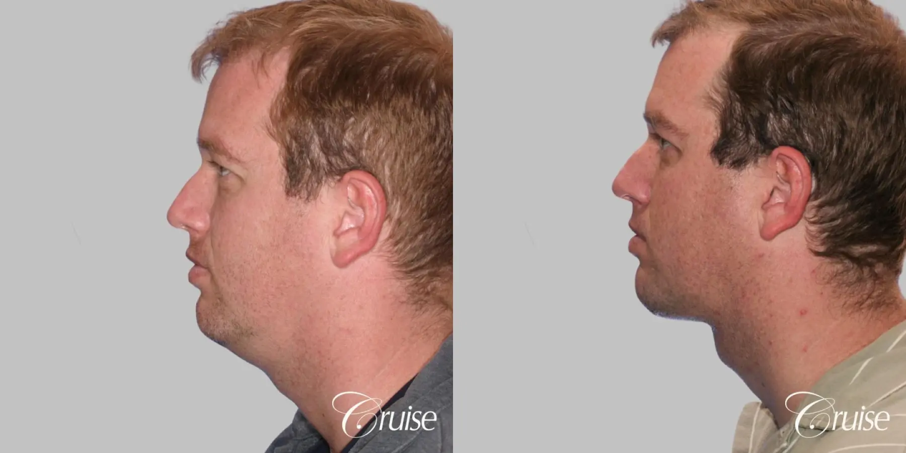 Lower Face Lift, Neck Lift, Neck Midline Plication - Before and After 2