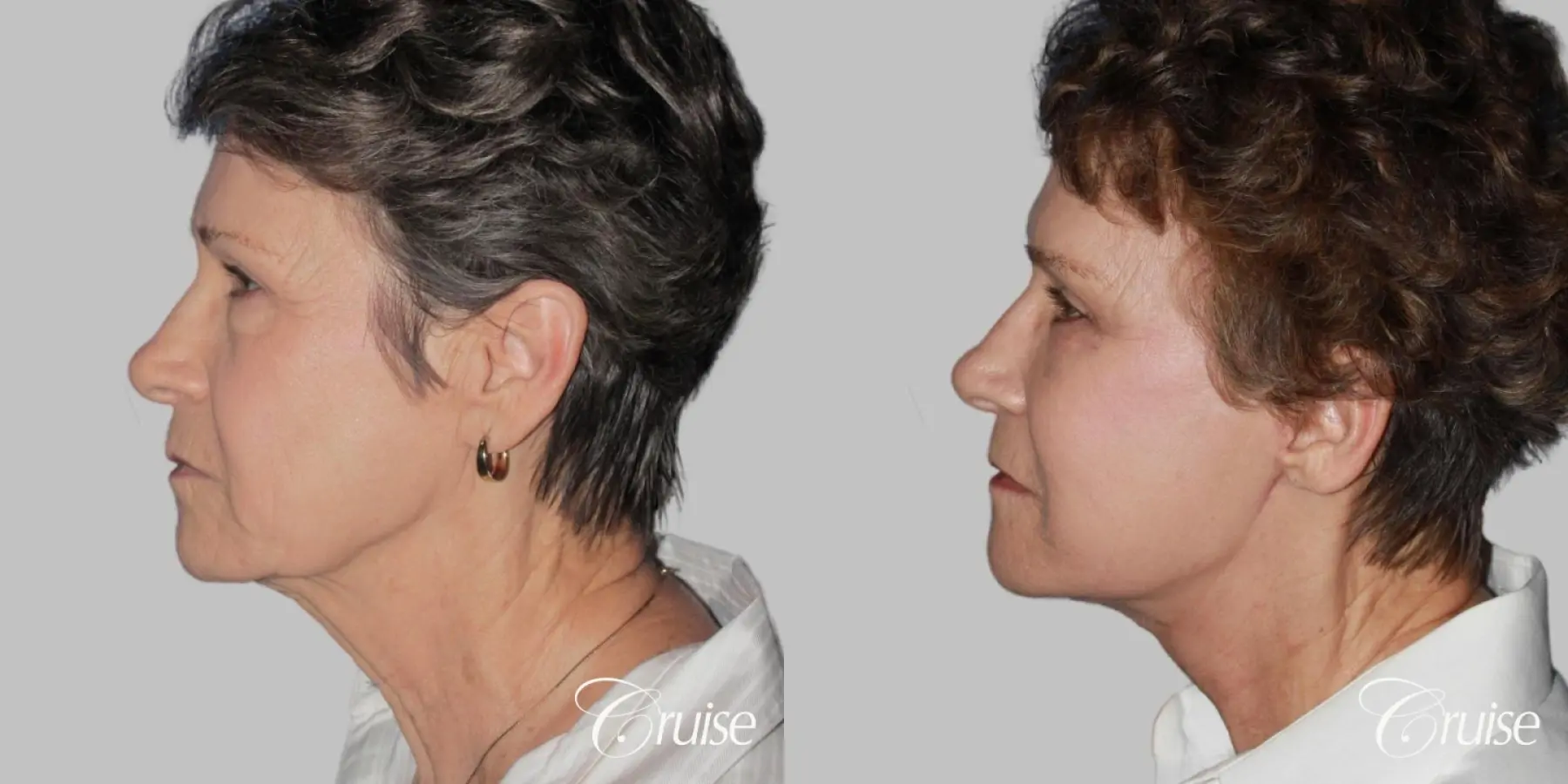 Female Facelift, Blepharoplasty, Necklift, and Temple Lift - Before and After 3