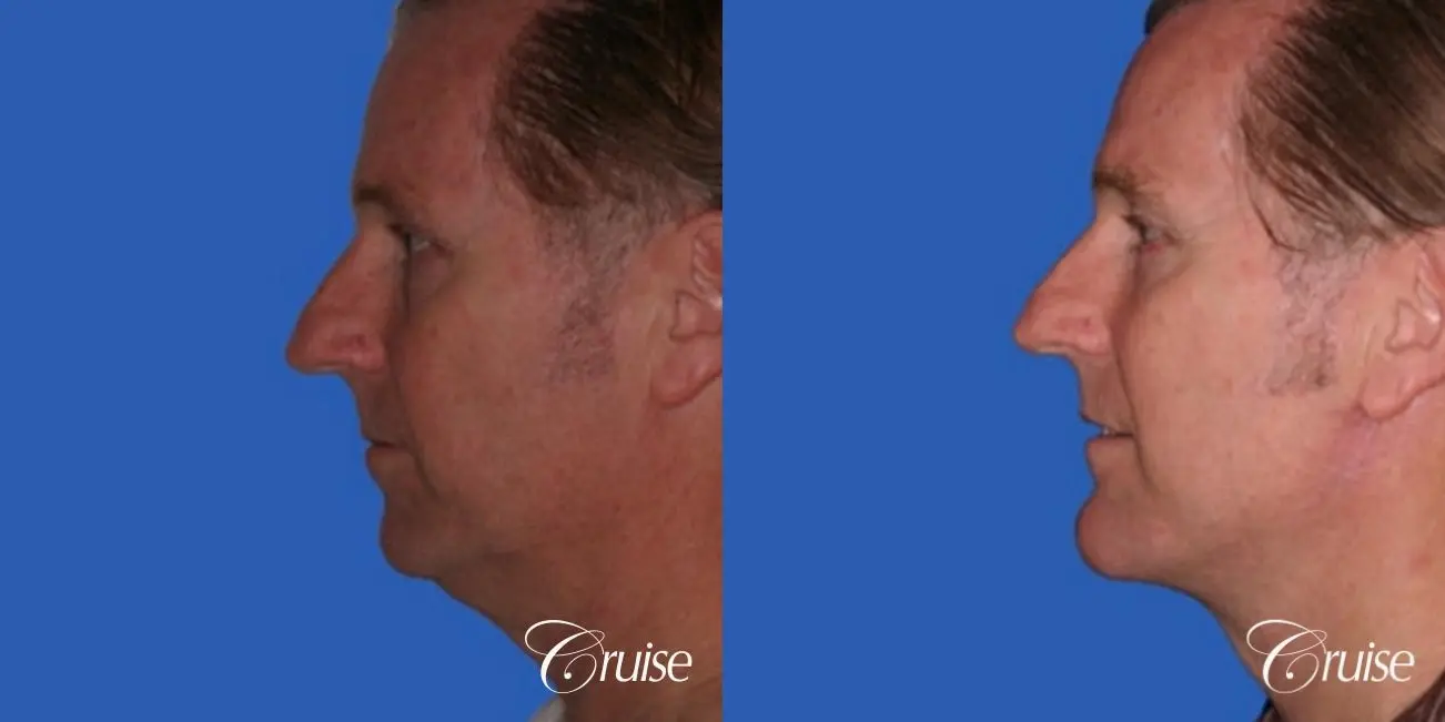 Neck Lift - Before and After 2