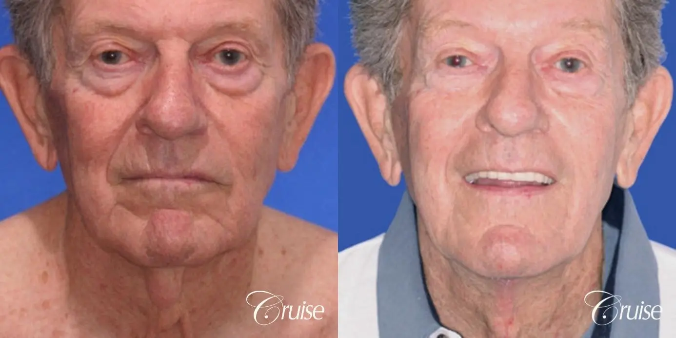 Neck Lift - Before and After 1